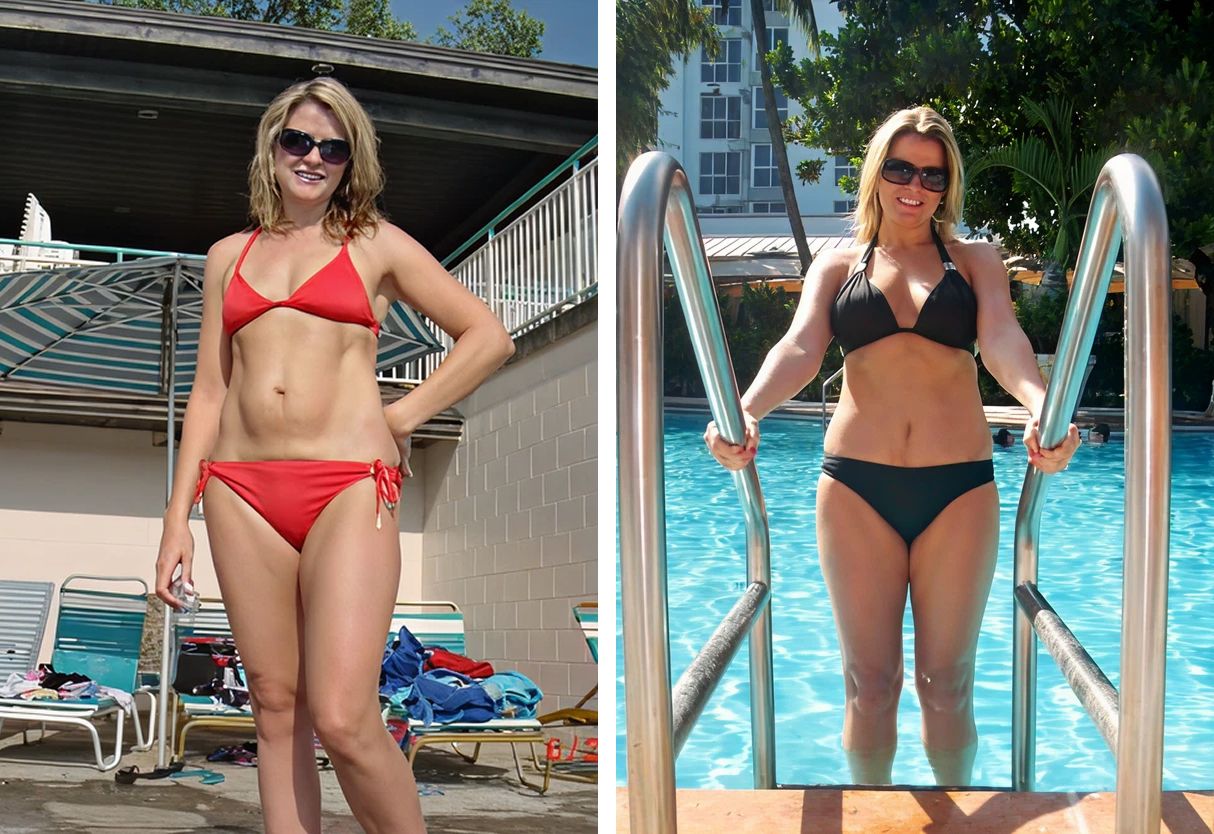Mommy Makeover patient after procedure