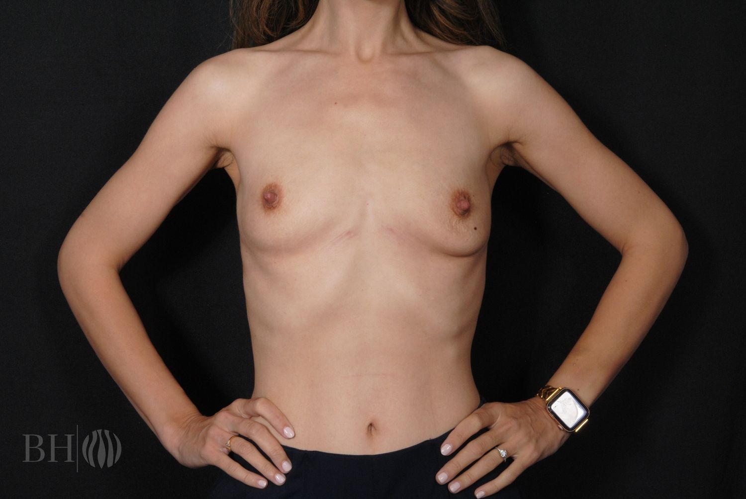 Breast Augmentation Before & After