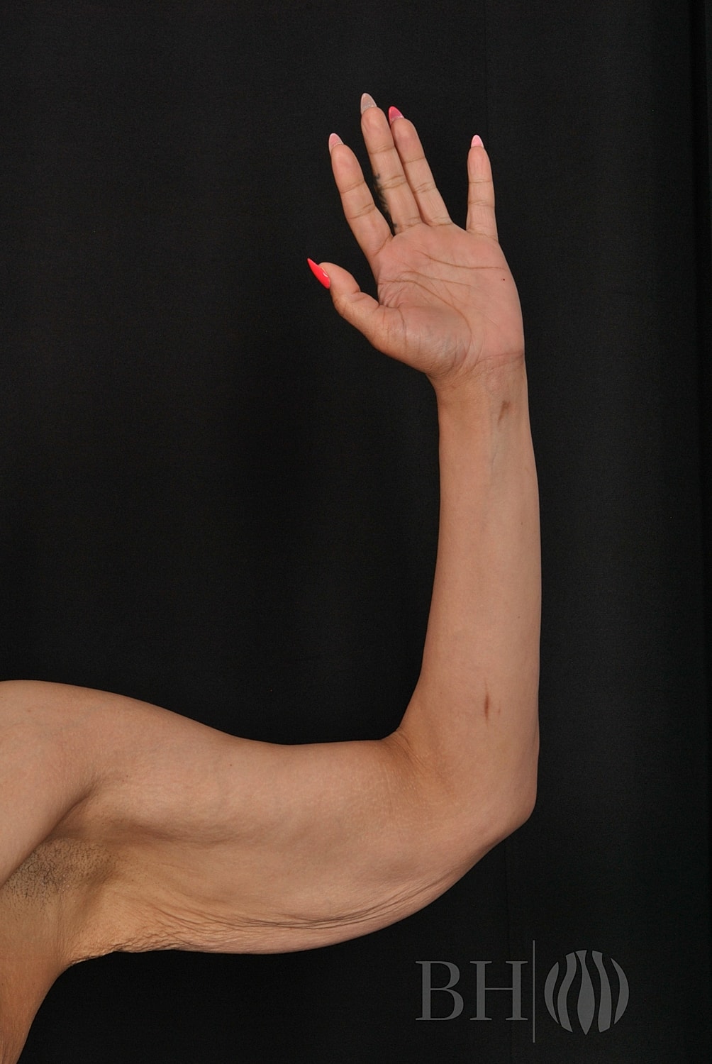 Arm Lift Before & After