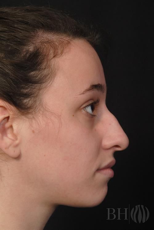 Rhinoplasty Before & After