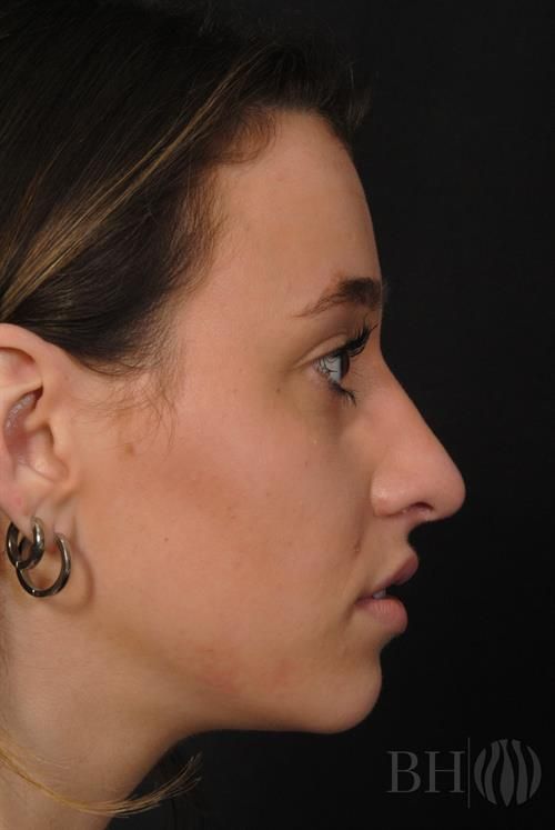 Rhinoplasty Before & After