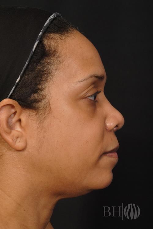 Rhinoplasty Before & After