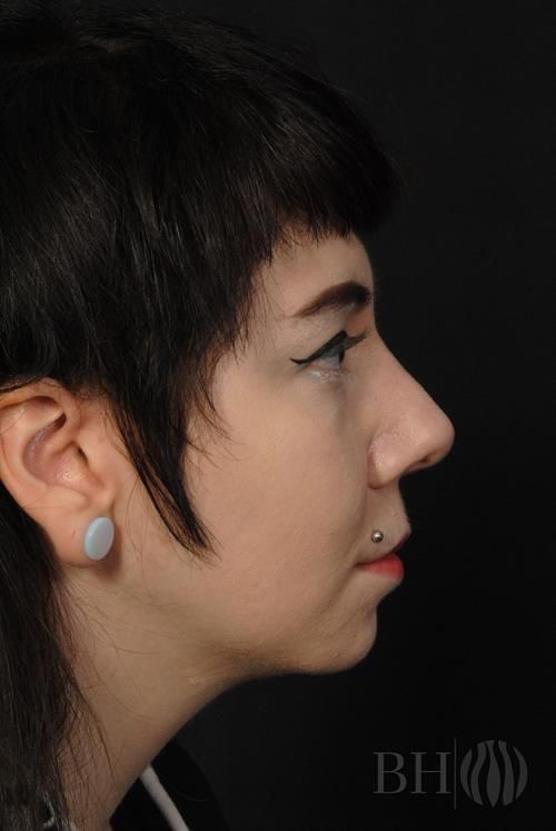 Rhinoplasty Before & After