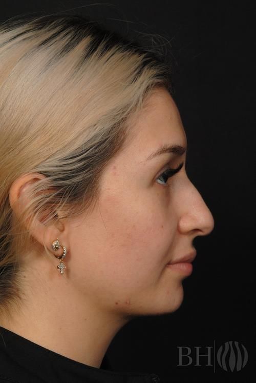 Rhinoplasty Before & After