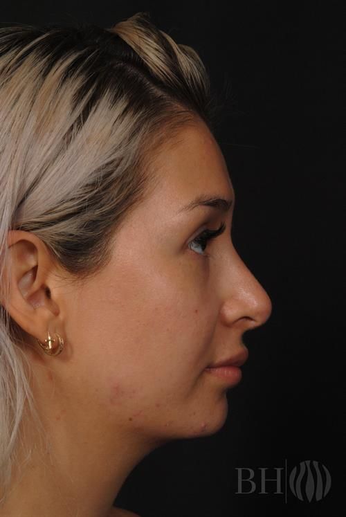 Rhinoplasty Before & After