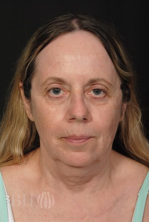 Facelift Before & After