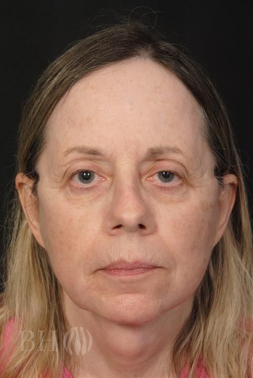 Facelift Before & After