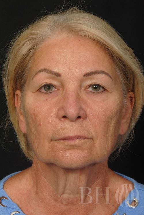 Facelift Before & After