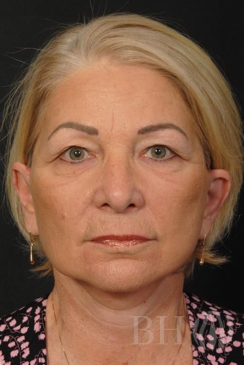 Facelift Before & After