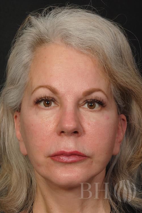 Facelift Before & After