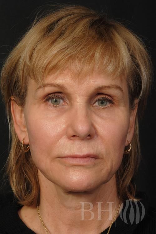 Facelift Before & After