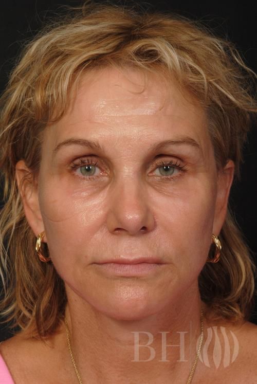 Facelift Before & After