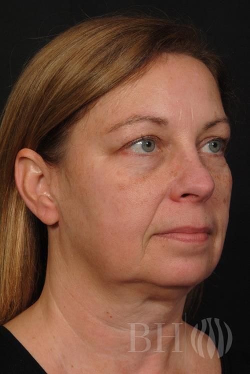 Facelift Before & After