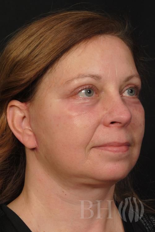 Facelift Before & After