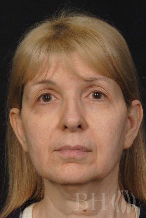 Facelift Before & After