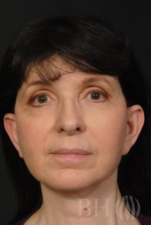 Facelift Before & After