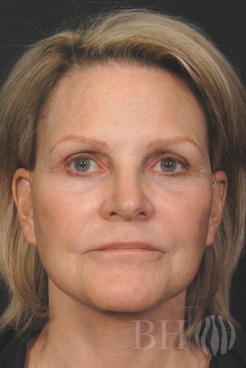 Facelift Before & After