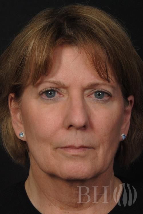 Facelift Before & After