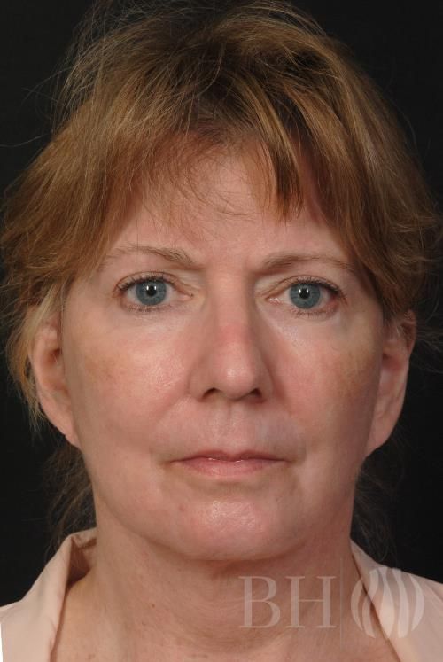 Facelift Before & After
