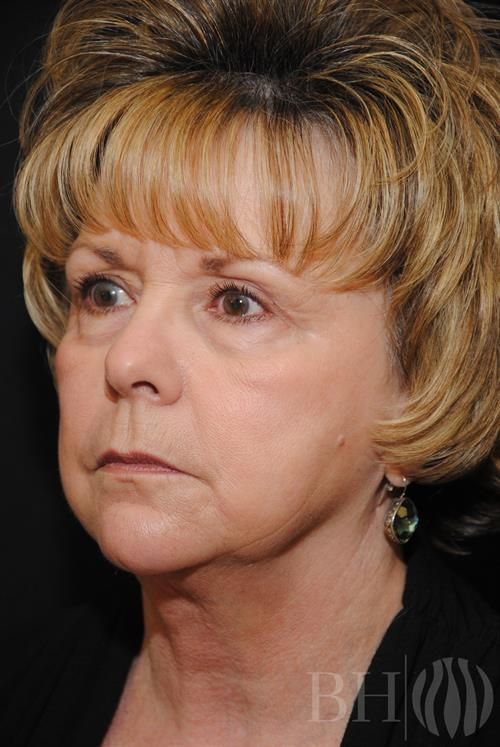 Facelift Before & After