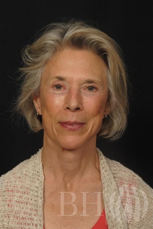 Facelift Before & After