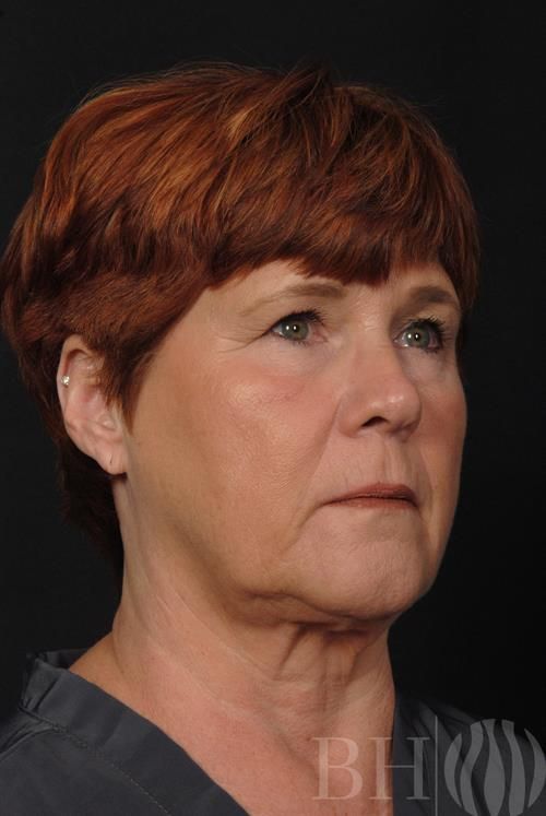 Facelift Before & After