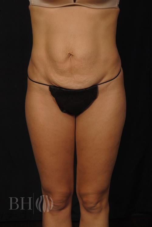 Tummy Tuck Before & After