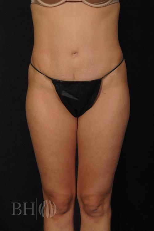 Tummy Tuck Before & After