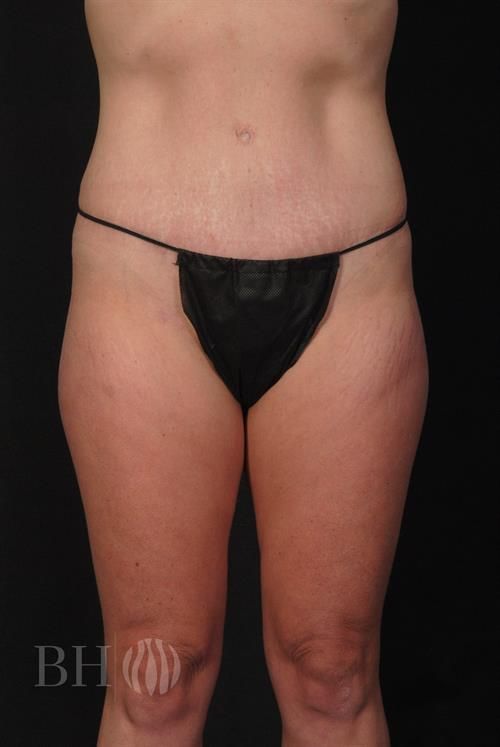 Tummy Tuck Before & After