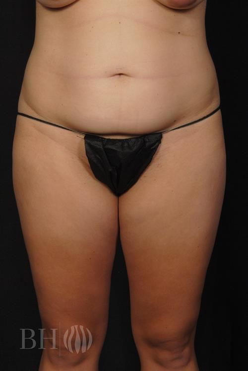 Tummy Tuck Before & After