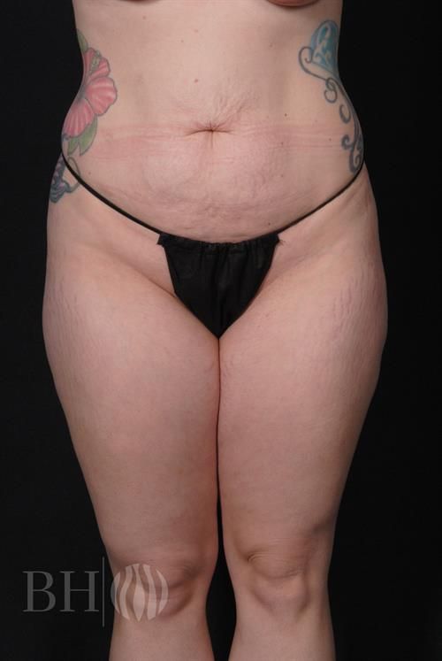 Tummy Tuck Before & After