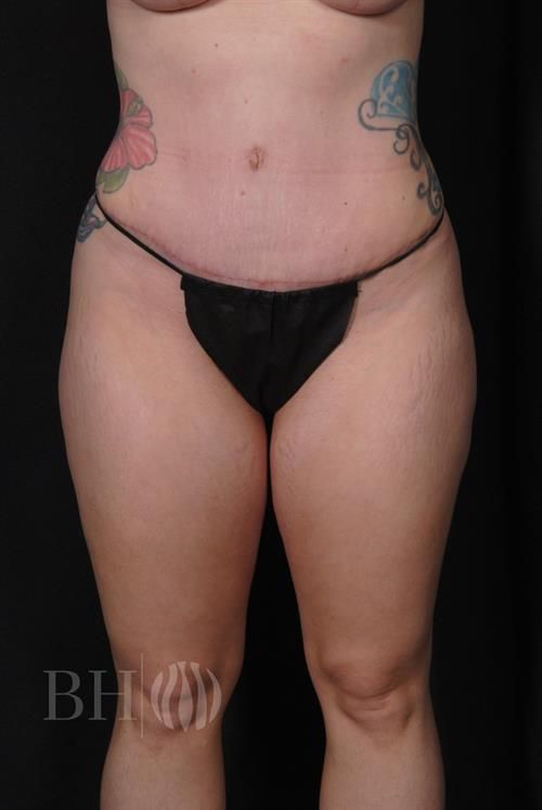 Tummy Tuck Before & After