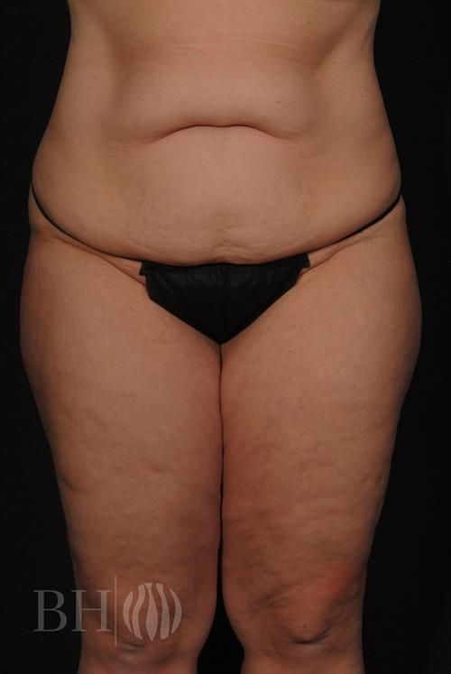 Tummy Tuck Before & After