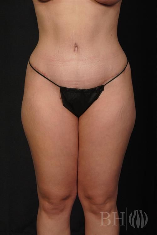 Tummy Tuck Before & After