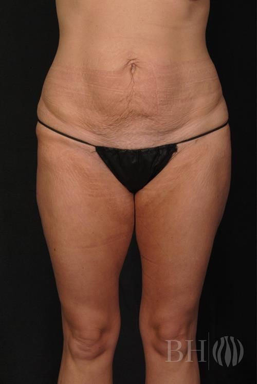 Tummy Tuck Before & After