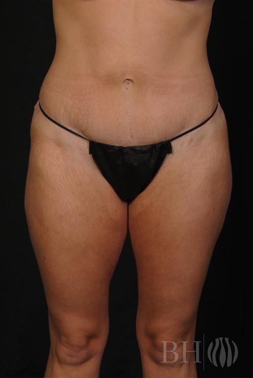 Tummy Tuck Before & After