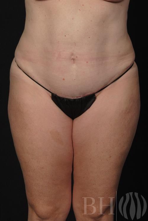 Tummy Tuck Before & After