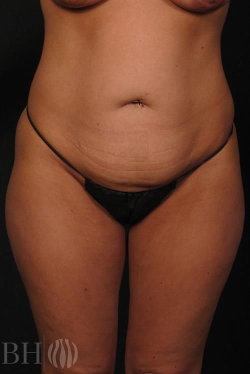 Tummy Tuck Before & After