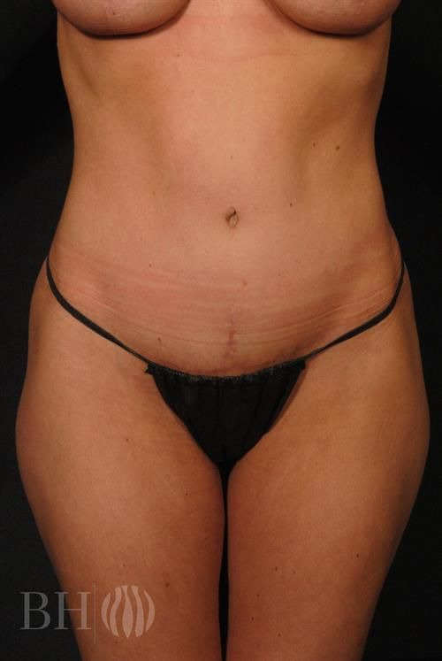 Tummy Tuck Before & After