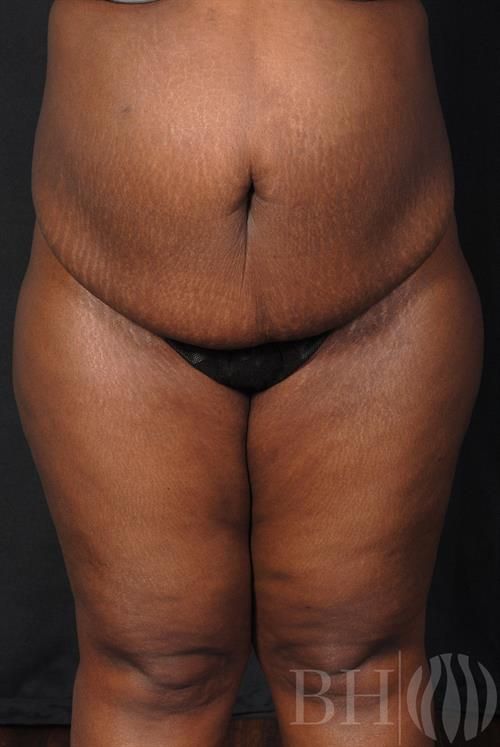 Tummy Tuck Before & After