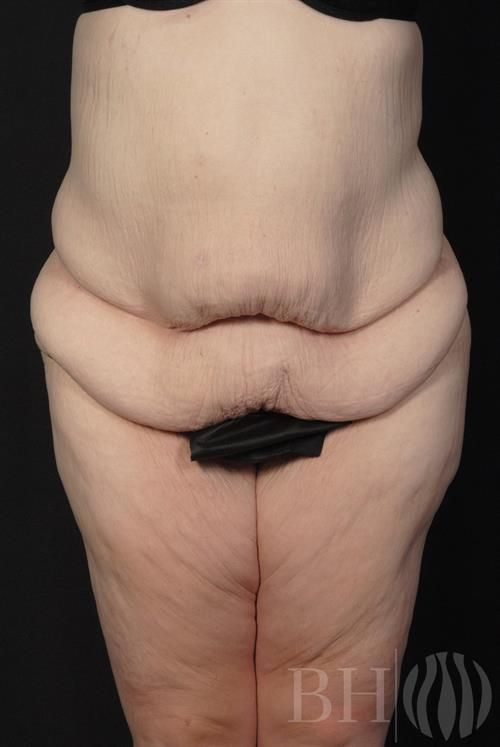 Tummy Tuck Before & After