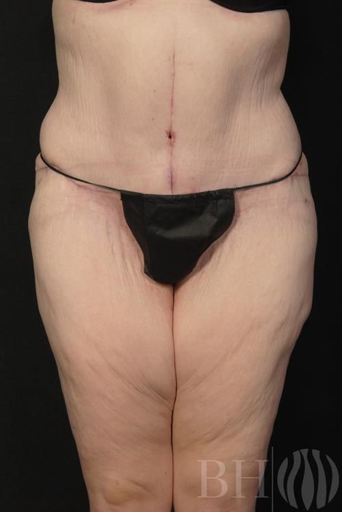 Tummy Tuck Before & After