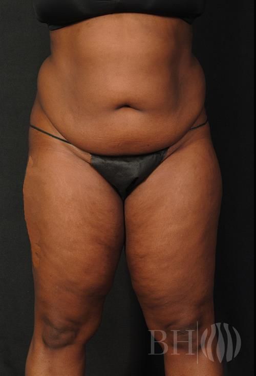 Tummy Tuck Before & After