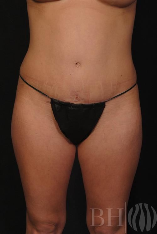Tummy Tuck Before & After