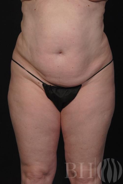 Tummy Tuck Before & After
