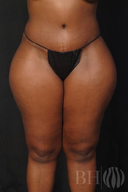 Tummy Tuck Before & After