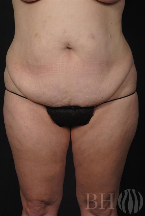 Tummy Tuck Before & After
