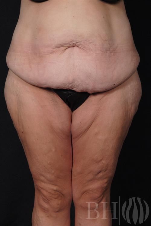 Tummy Tuck Before & After