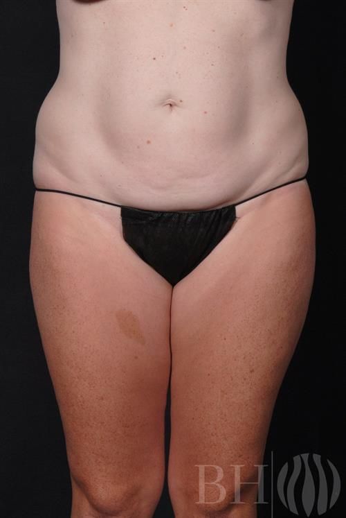 Tummy Tuck Before & After