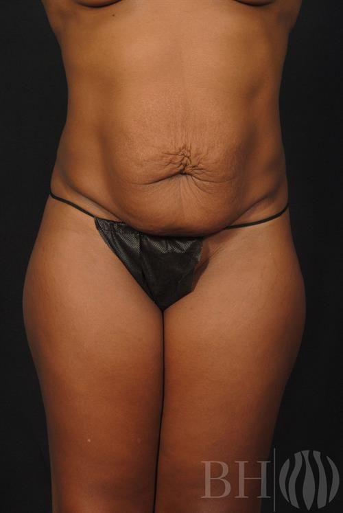 Tummy Tuck Before & After